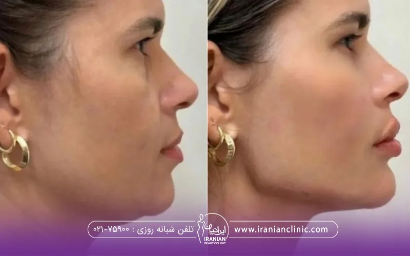 قبل و بعد زنی که زاویه سازی فک انجام داده است